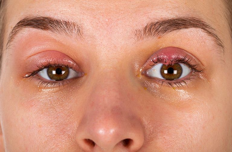 chalazion vs stye