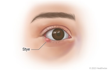 chalazion-stye4