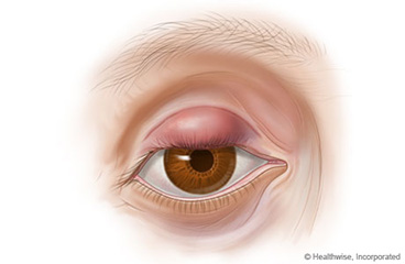 chalazion-stye5