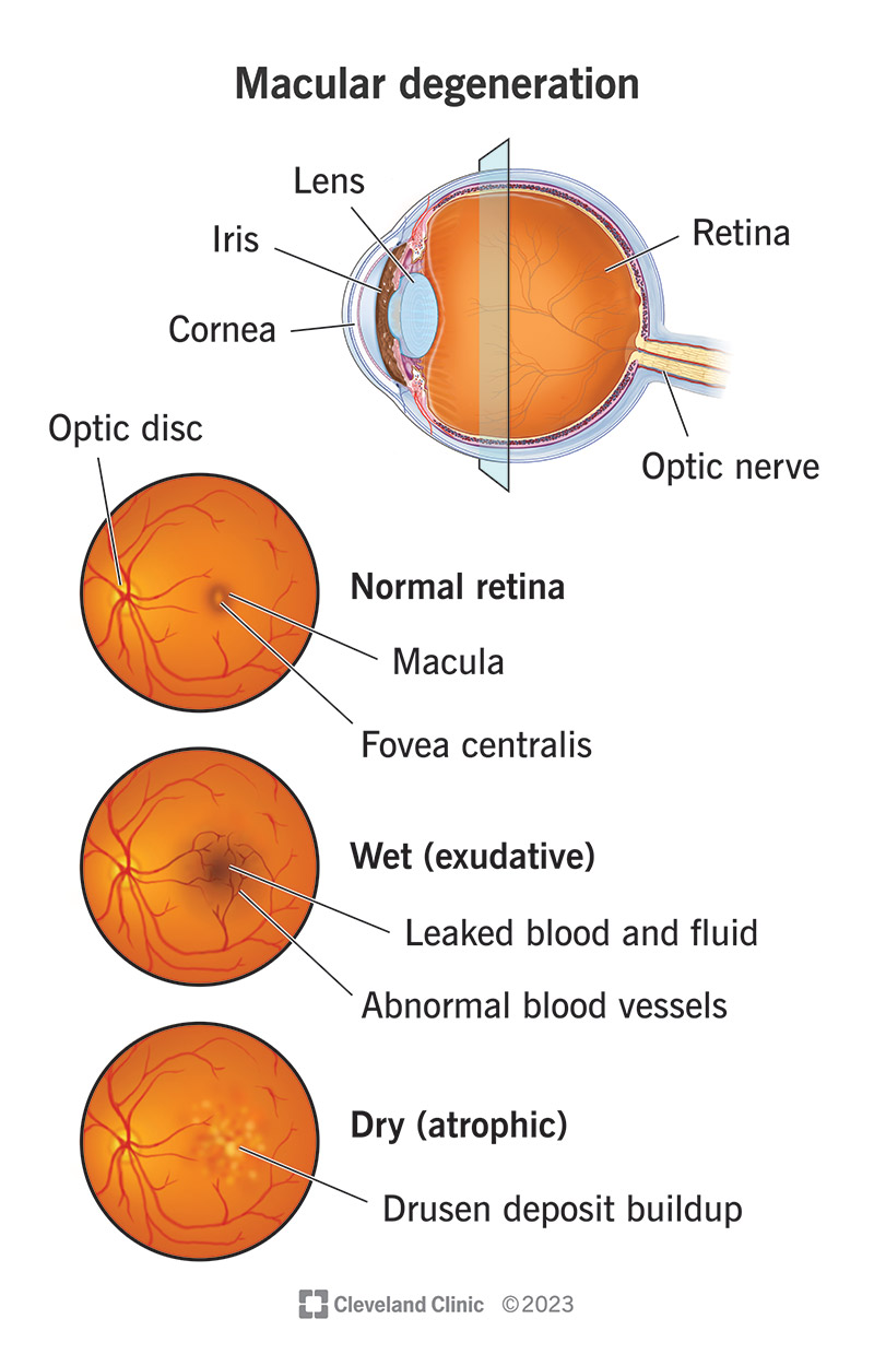 types of macular degeneration