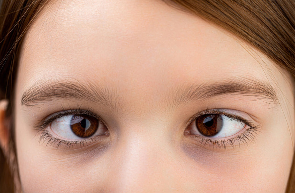 A close-up of a young girl with crossed eyes.